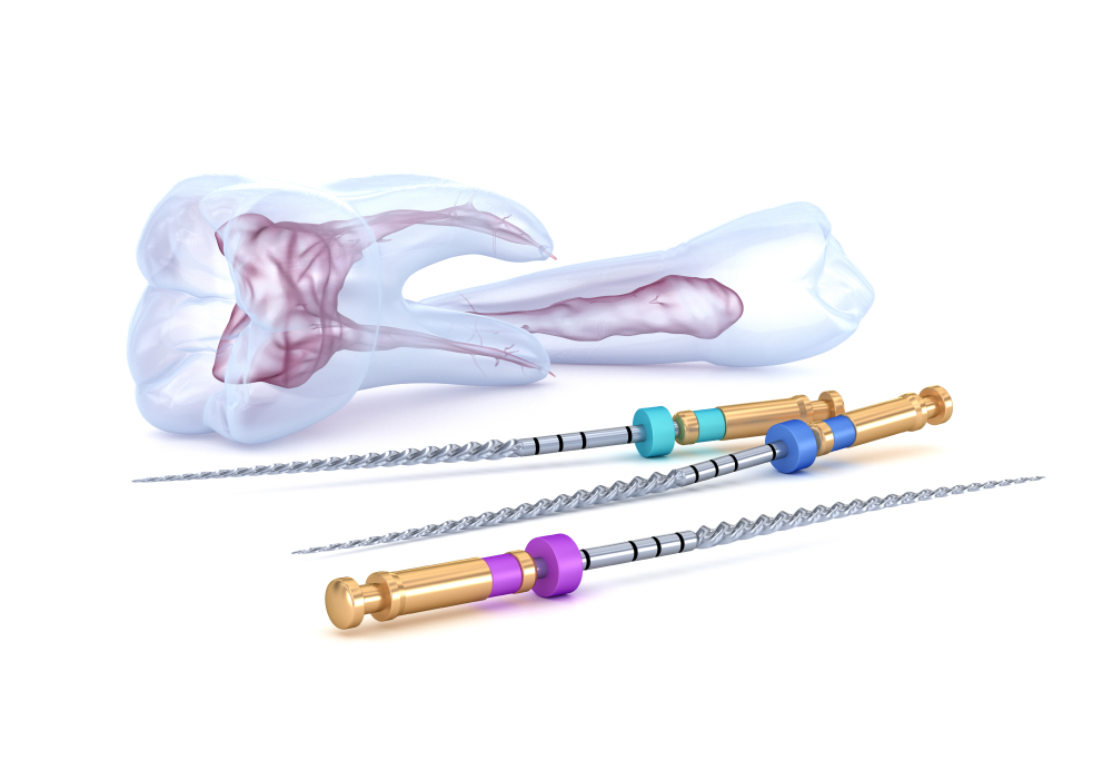 ニッケルチタン