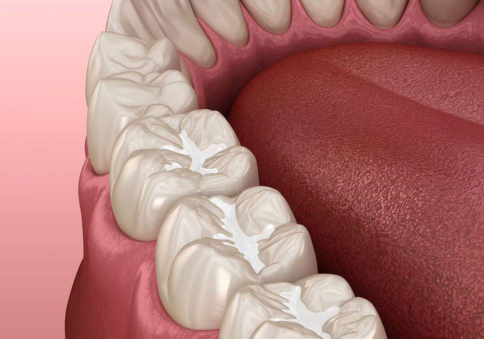 シーラントとは